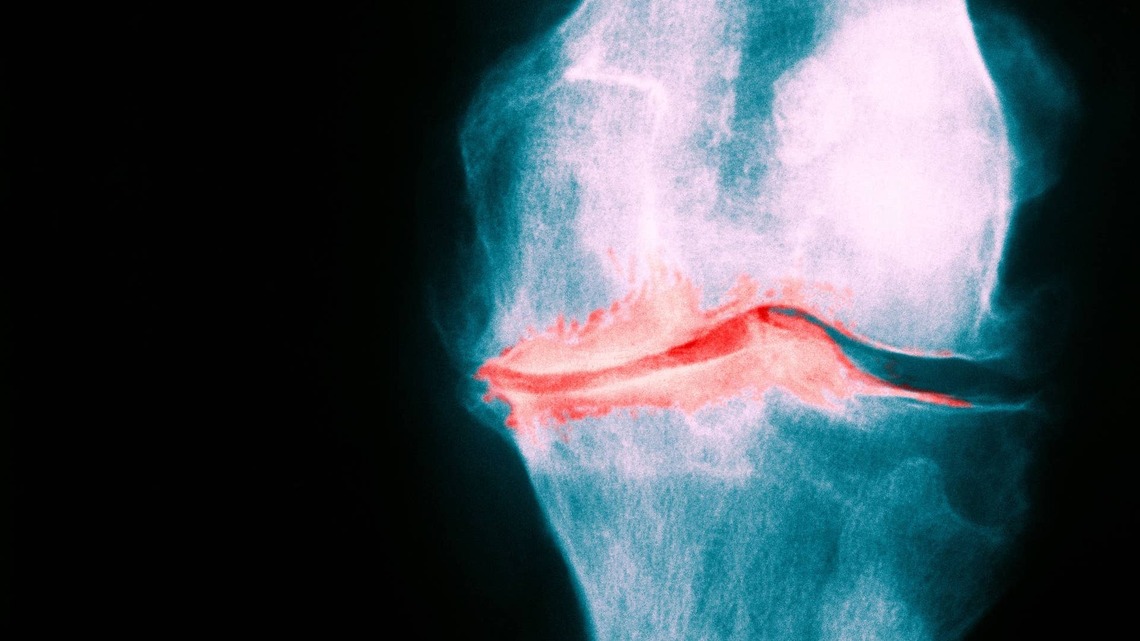 Breakthrough Osteoarthritis Study Offers Hope Without Surgery 