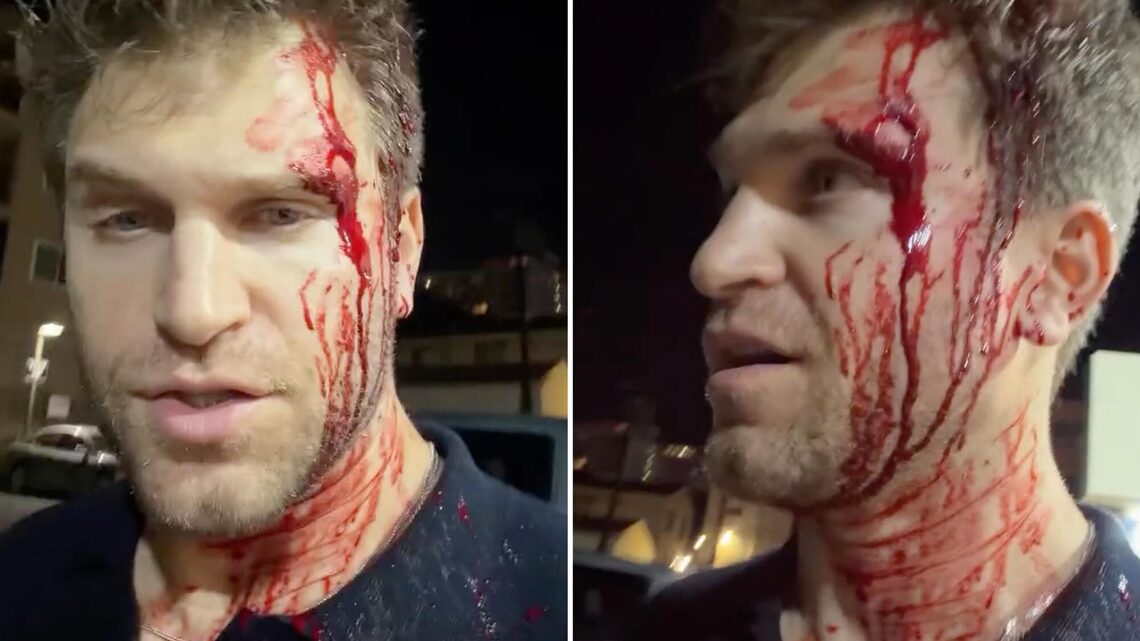 'PLL' Alum Keegan Allen Shows Bloody Face After Being Robbed at Gunpoint 