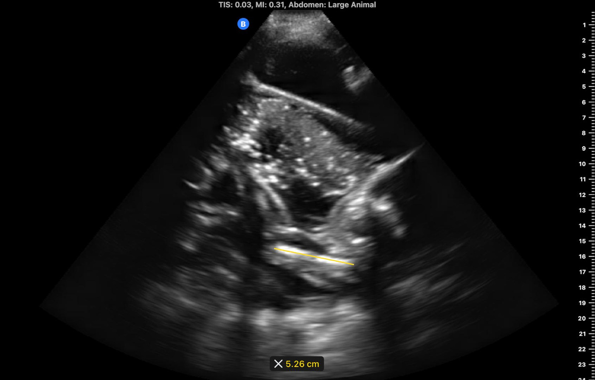 A Butterfly Network ultrasound gave Olympia's caregivers important information regarding changes to Olympia's amniotic fluid, positioning and fetal heart rate, according to Dr. Sachita Shah of Butterfly & UW Emergency Medicine.