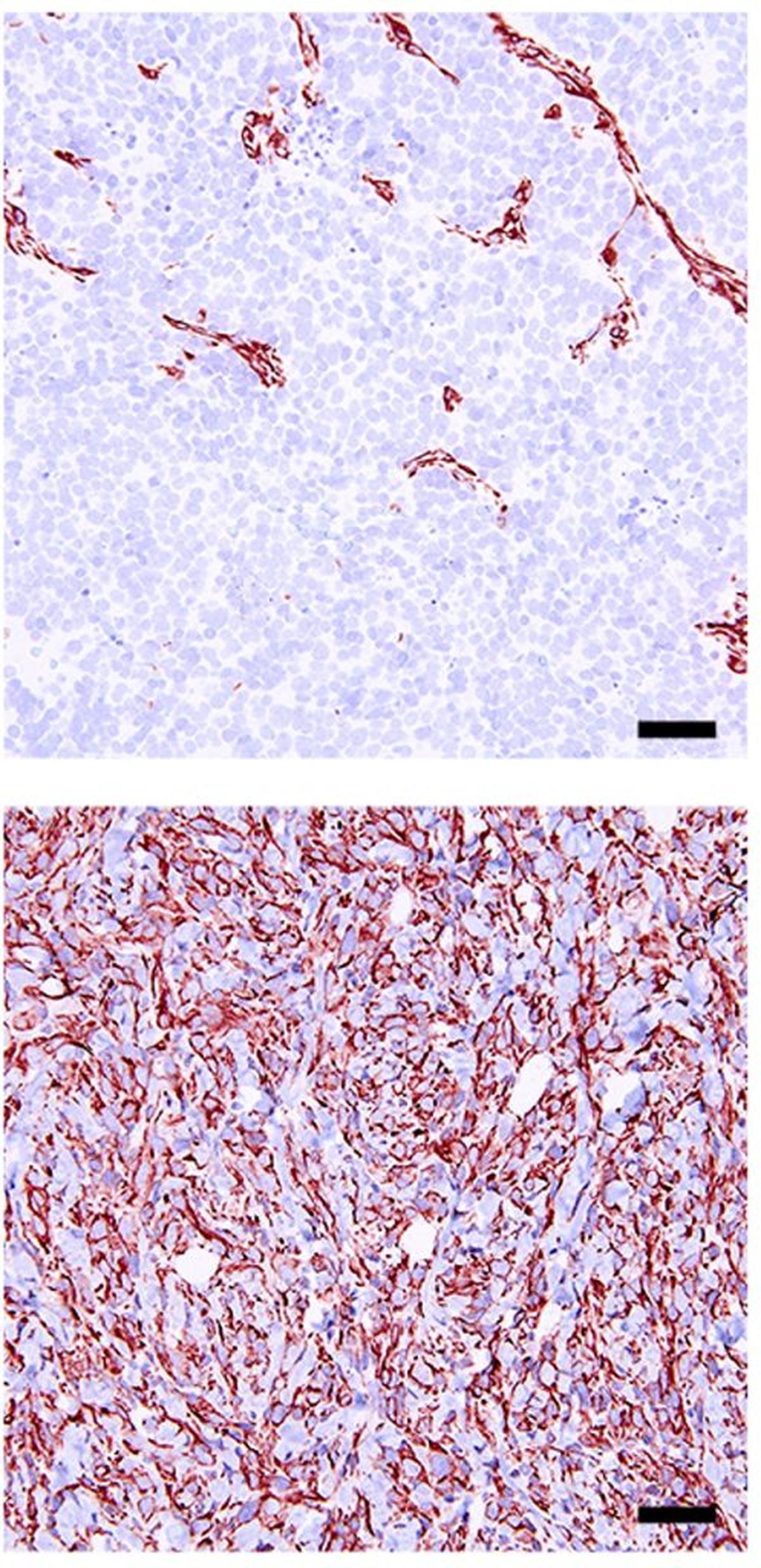  Positively stained NEPC markers (top) are lost when Sirt1 is silenced (bottom). (Nunes de Almeida et al via SWNS) 