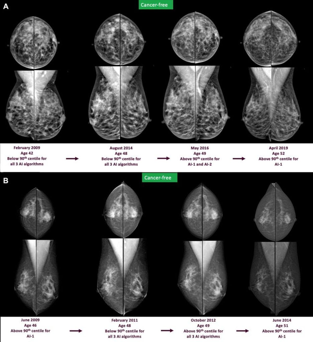  Screening mammograms and artificial intelligence (AI) score changes over time in two individuals who remained cancer-free. (RSNA via SWNS) 