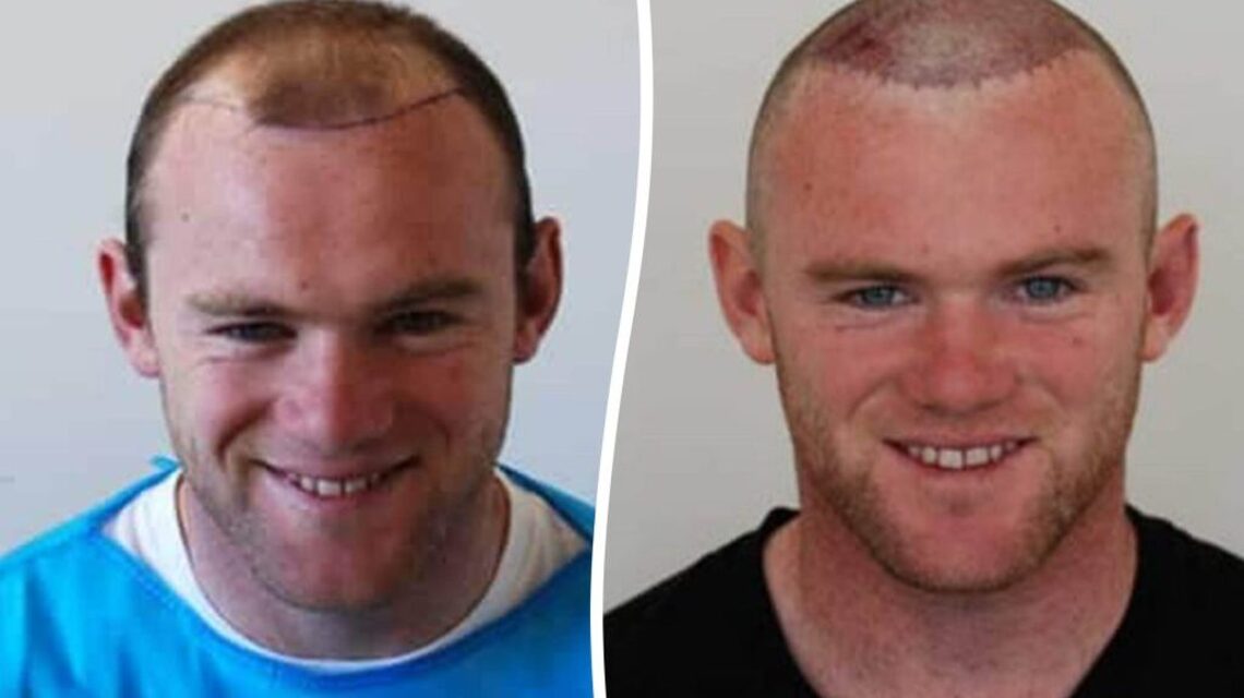 Clinic behind Wayne Rooney's hair transplant gets 5 requests a day for the ‘Rooney'