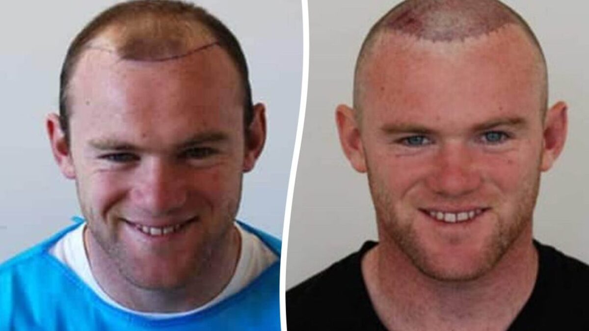 Wayne Rooney before and after the hair transplant procedure. (Harley Street Hair Clinic via SWNS). 