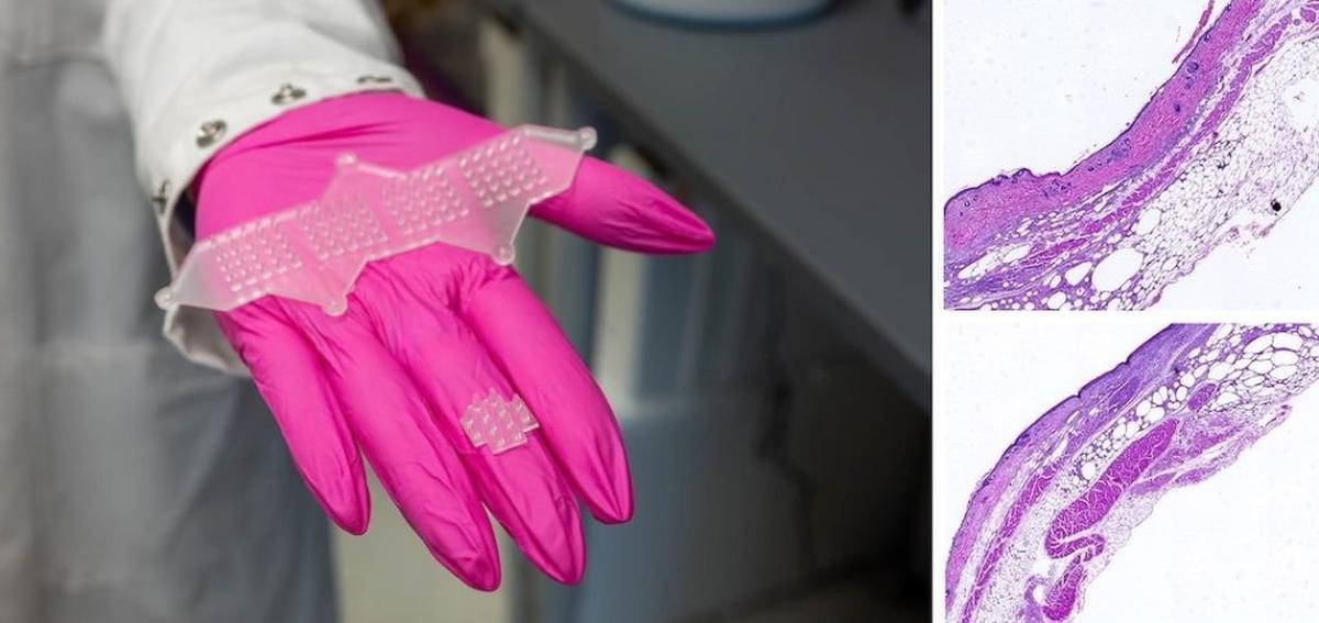 Wound-healing patches can vary in size and present indentations housing cytokine-secreting cells (right). In preclinical studies, delivery of cytokines using the patch supported accelerated wound healing: histology image show healed healthy skin (top left) vs. wounded skin (bottom left). (Jared Jones / Rice University / Veiseh lab via SWNS) 