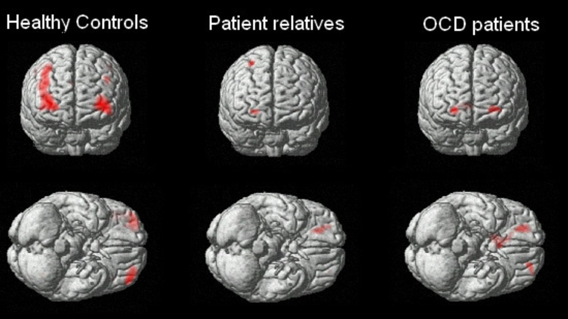 Health Rounds: Scientists find genes linked to OCD, raising the prospect of new treatments