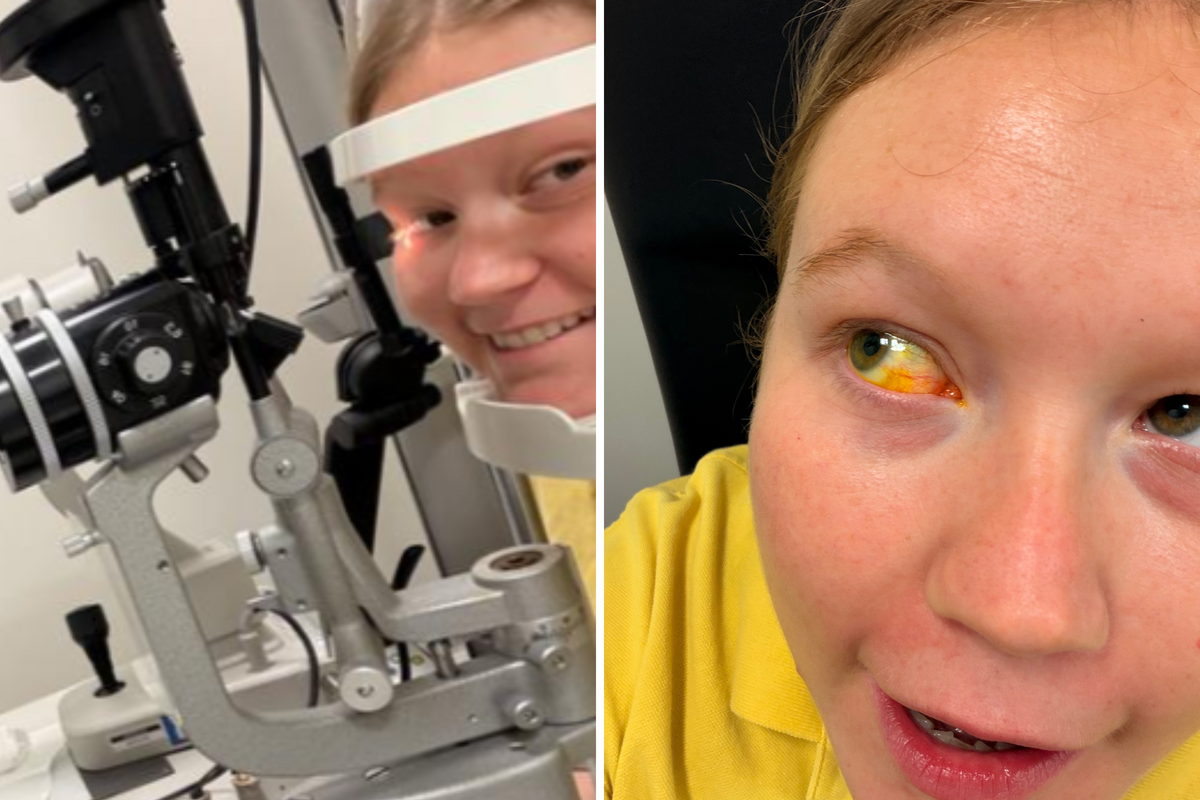  Alabama Jackson having an eye assessment and after the blisters were popped. 