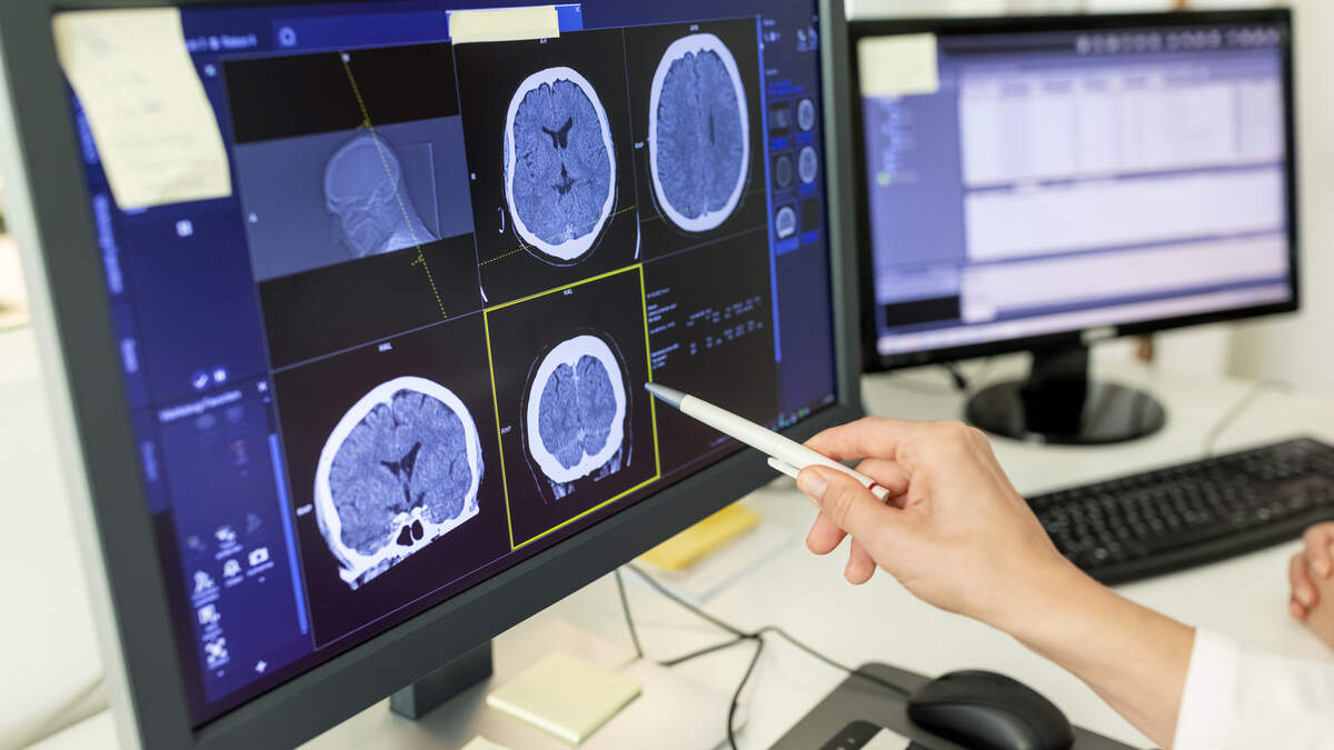 An estimated 30,000 to 40,000 people in the U.S. each year are diagnosed with meningioma - the most common brain tumor in adults.