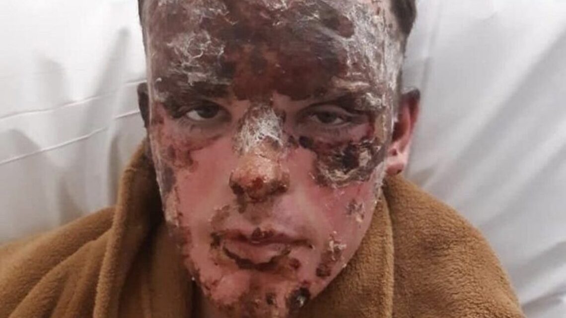 Man wins six-figure settlement after workplace explosion left him scarred