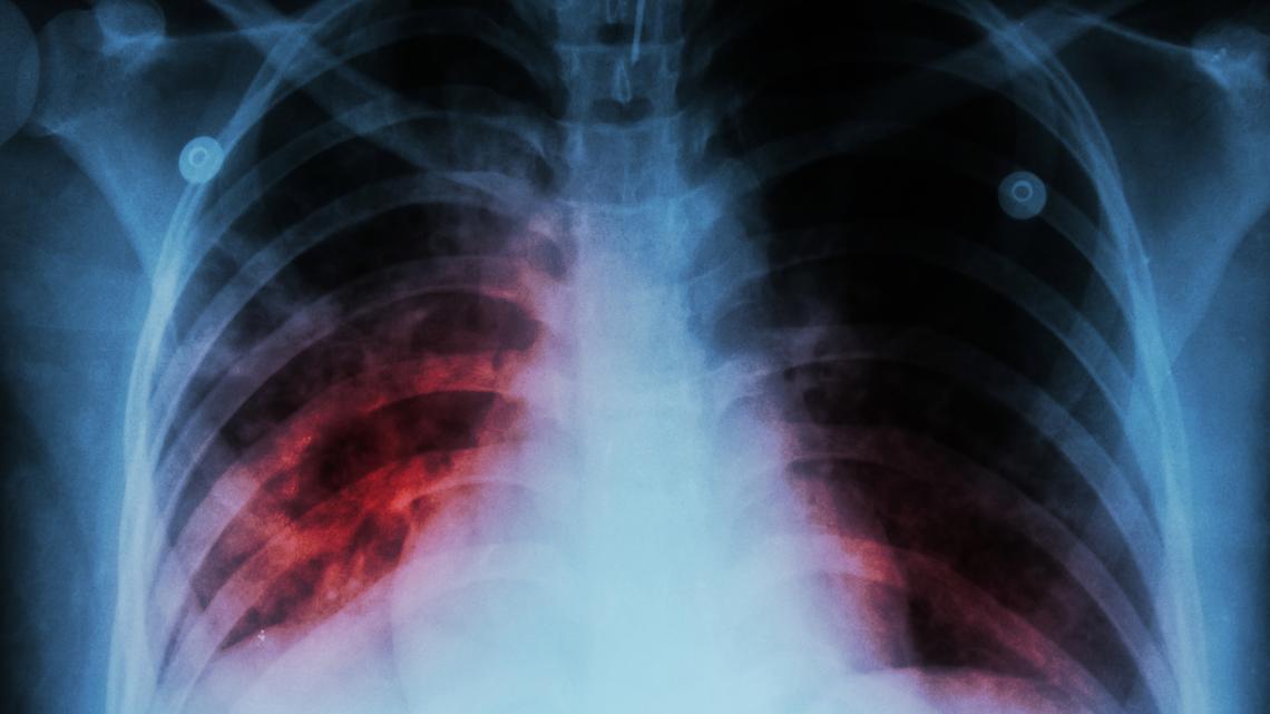 Tuberculosis cases have been rising as public health agencies struggle to keep up 
