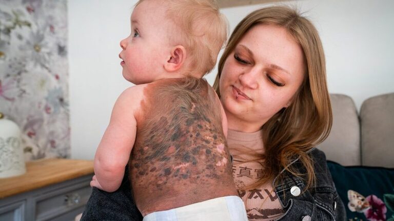 Family finds out baby's ultra-rare birthmark is cancerous