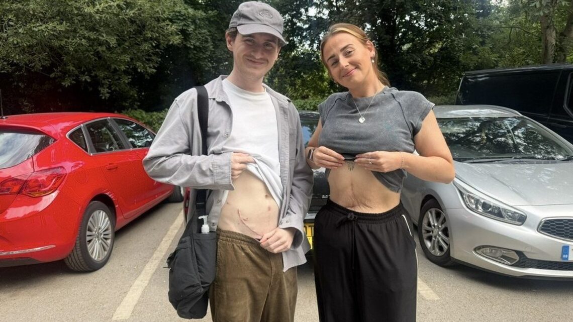 Sister donates kidney to brother battling rare diagnosis