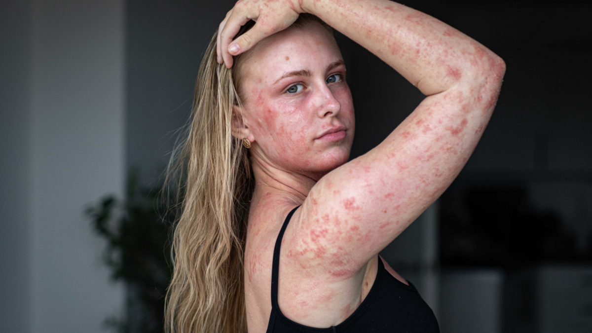 Sophie has red, sore and bleeding skin covering 95% of her body, also known as topical steroid withdrawal. (William Lailey via SWNS). 