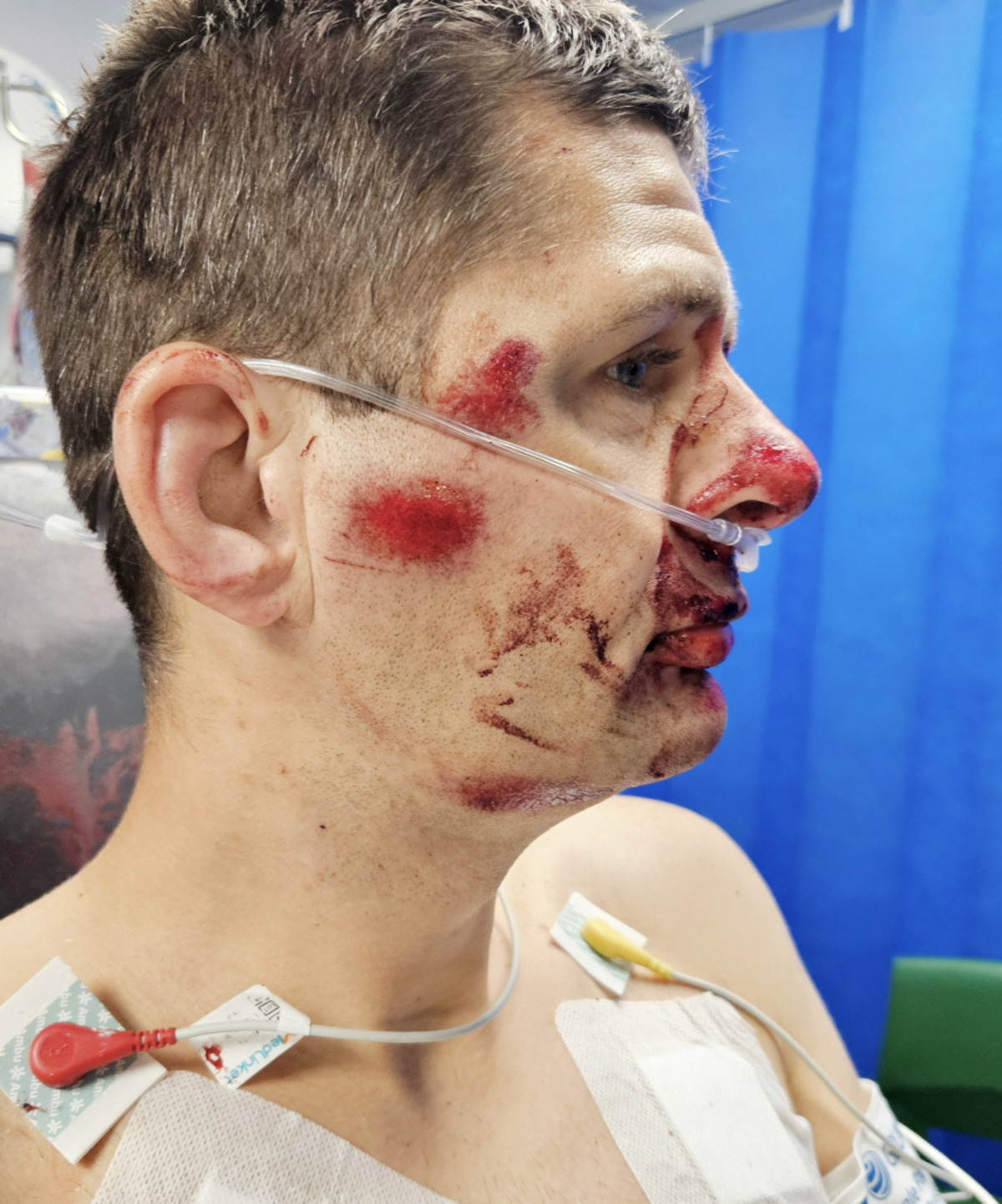  Mike Stubbs was left with extensive injuries including a head cut requiring 20 stitches, fractured chest bone in two places. (Irwin Mitchell via SWNS) 