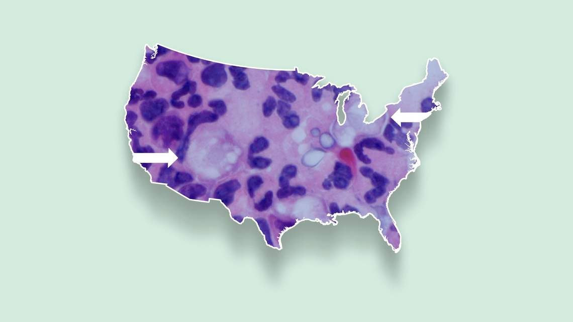 Brain-eating amoeba map shows which states have the most cases