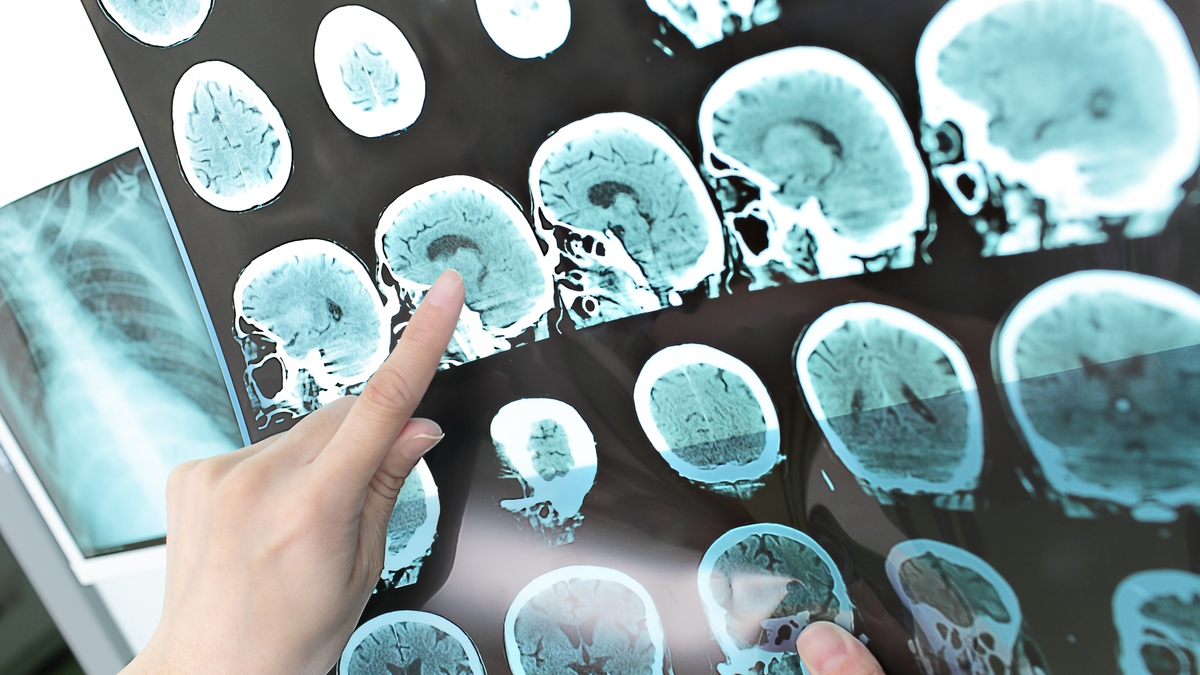 Mayo Clinic researchers and collaborators have shown that artificial intelligence can reveal brain tumor risks.