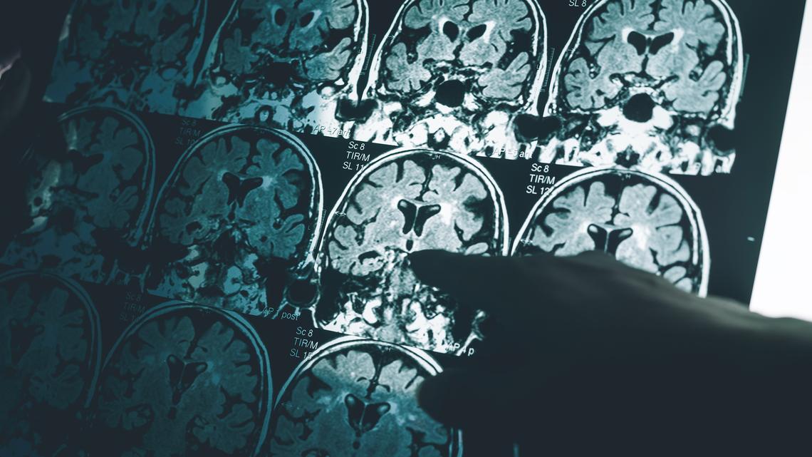 Alzheimer's deaths increase as population ages, lifespans increase 