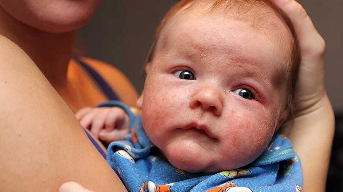Eczema vs. psoriasis: How to tell these common skin conditions apart 
