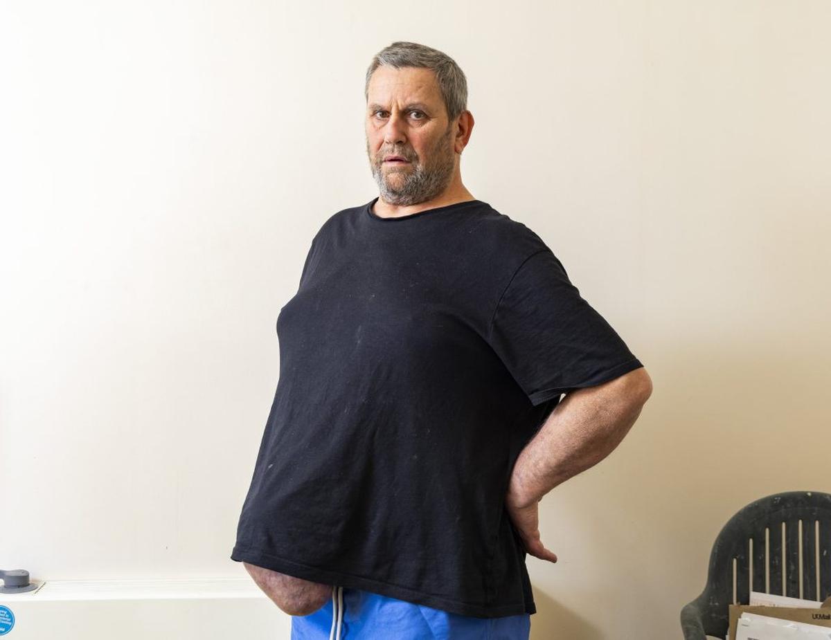  Burden was forced to fundraise after being denied surgery by NHS. (Tom Wren via SWNS) 