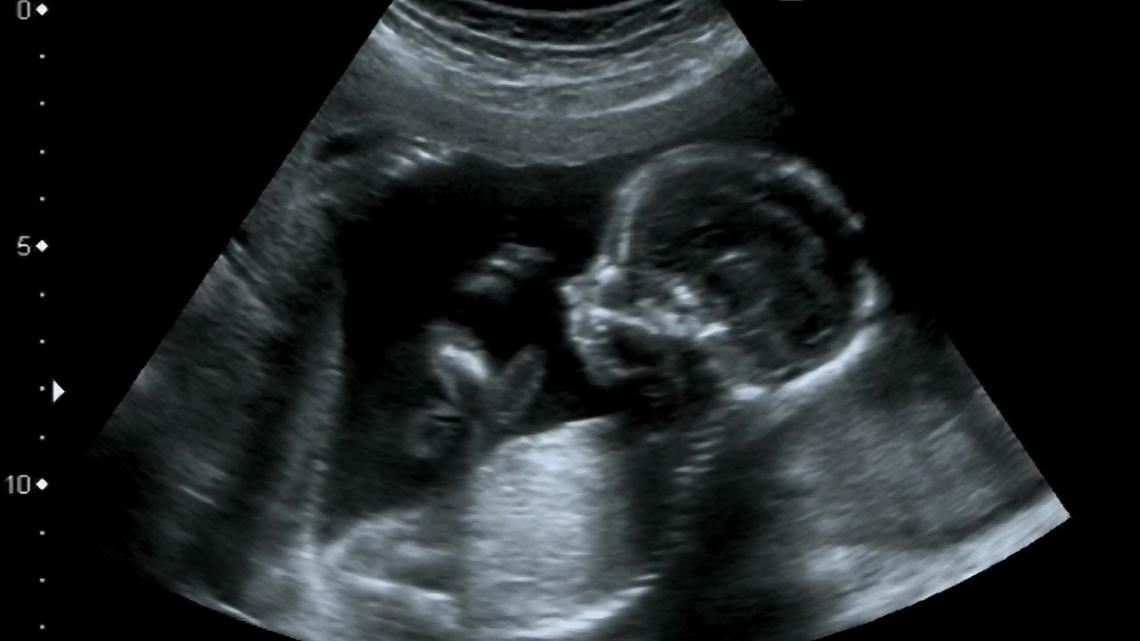 This company's AI could flag premature births based on ultrasounds 