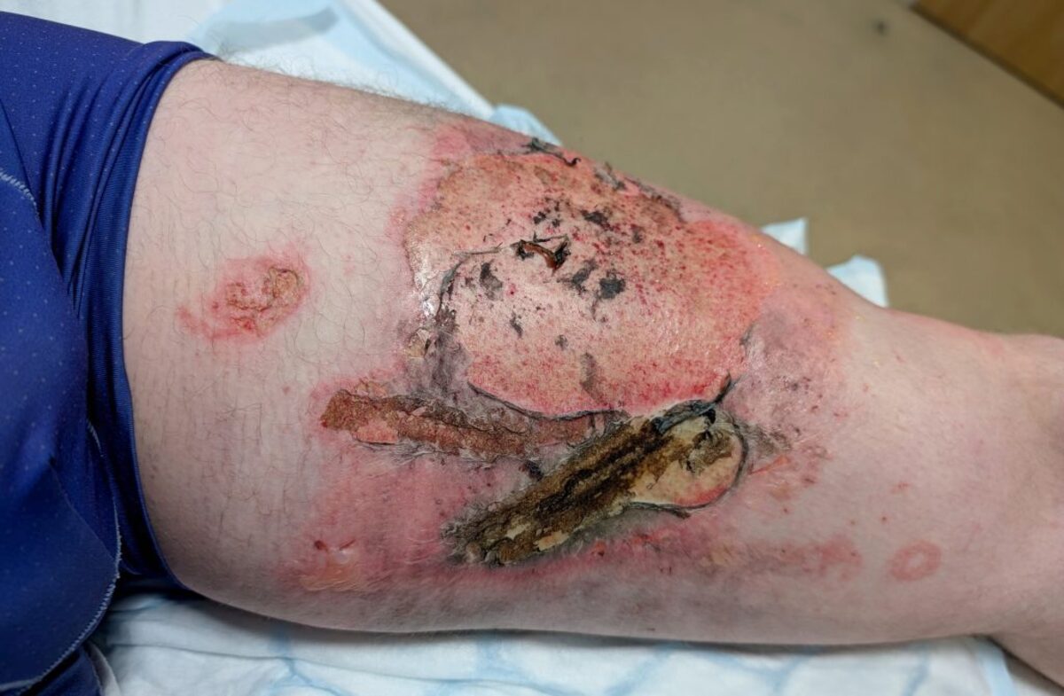  Gavin Sutherland suffered serious burns to his leg after a vape battery exploded in his pocket. (SWNS) 