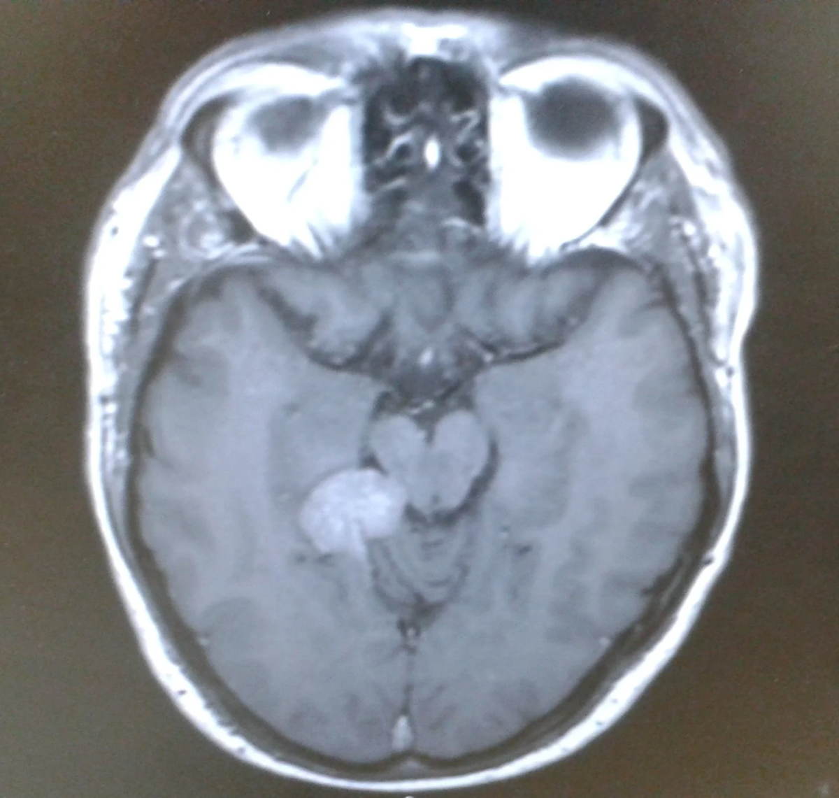  Darren Harris's brain scan. (Brain Tumor Research via SWNS) 