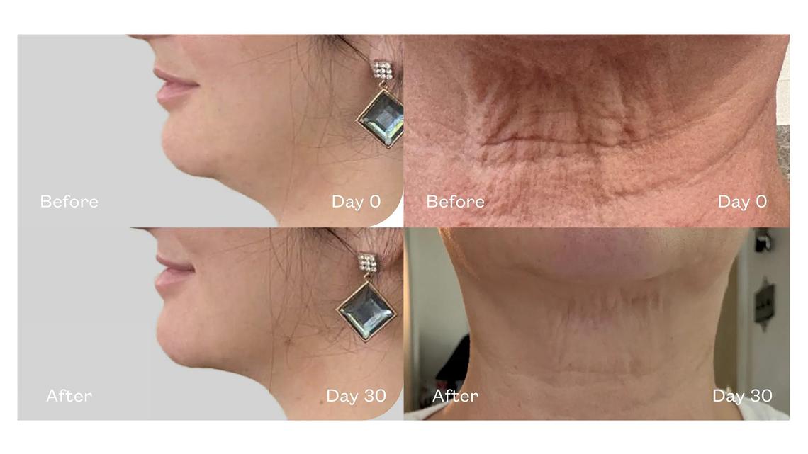 Sagging Jowls? This Serum Sculpts the Jawline and the Neck in Days 