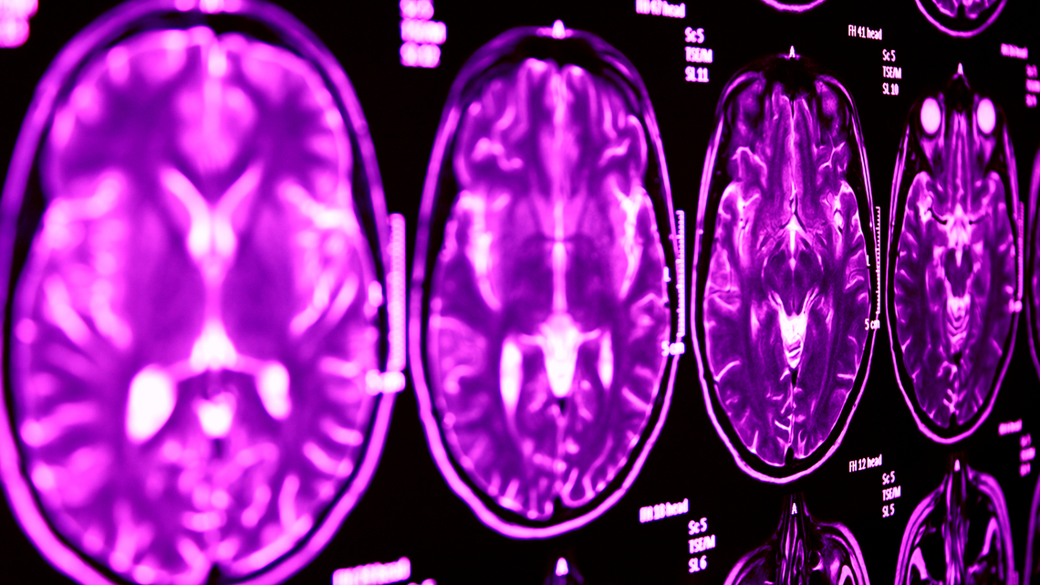 Mayo Clinic Minute: Understanding brain aneurysms and treatment options