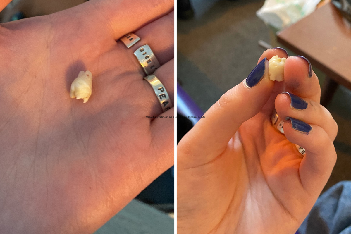  Oli holds the tooth that was found inside her ovarian tumor. 