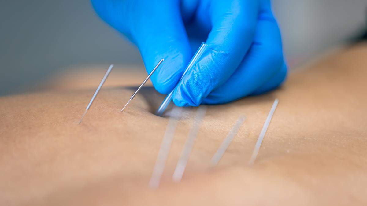 Dry needling -- the insertion of ultrathin needles into trigger points to loosen them -- was codified by the American Medical Association as an acceptable form of therapy in 2016. Since then, it has become a standard part of orthopedic care.