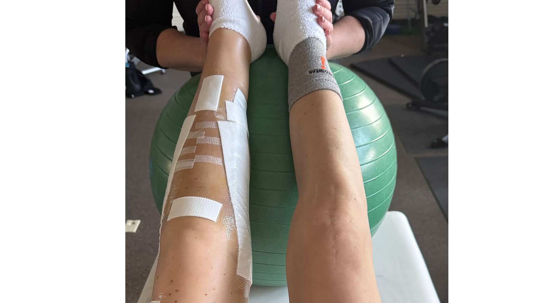 Lindsey Vonn Shares Dramatic Picture of Her Legs After Multiple Surgeries 