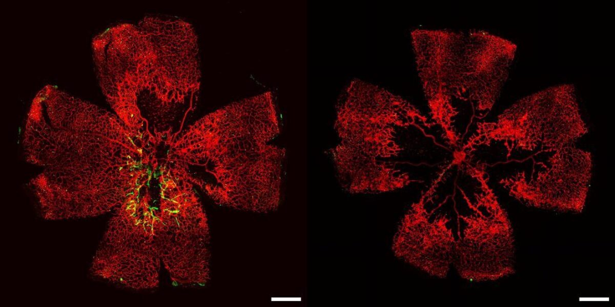  This image depicts a mouse's retina suffering from conditions similar to diabetic retinopathy both before (right) and after (left) being treated with human lab-grown retinal endothelial cells. (Duke University via SWNS) 