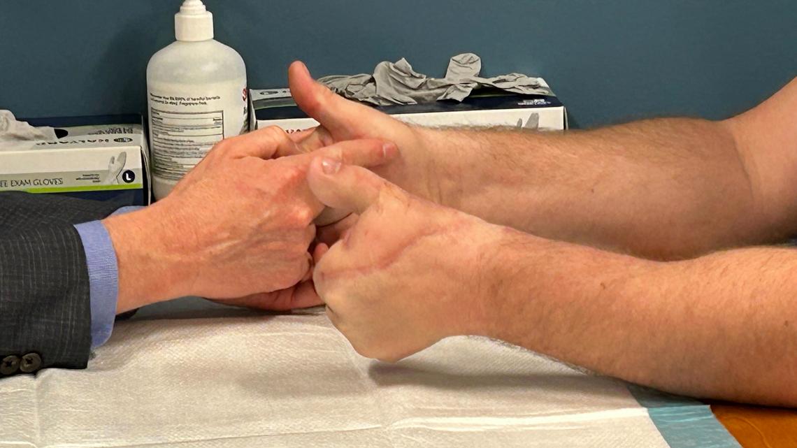 Revolutionary toe-to-thumb surgery restores hand function after devastating injuries 