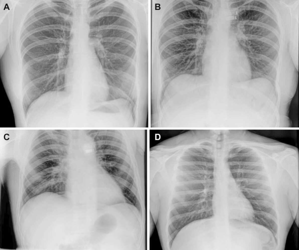  Representative preflight, in-flight, and postflight chest radiographs. Radiographs of the chest were acquired (A) preflight by a crewmember, (B, C) in-flight on day 3 after launch (L+3) by a crewmember, and (D) postflight by a non-crew operator using the same imaging protocol. (RSNA via SWNS) 