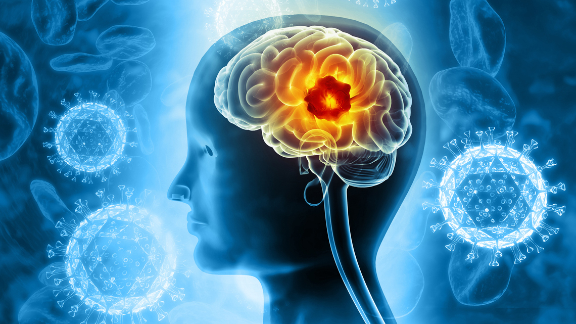 The Deadliest Brain Cancer Has No Cure-a New Approach May Change That 