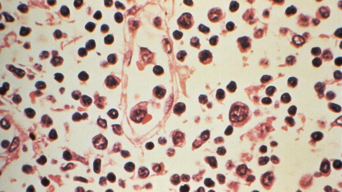 FILE PHOTO: Some of the cytoarchitectural features in a lymph node specimen extracted from a patient suspected of a Hantavirus illness is seen in this handout photo obtained by Reuters, July 6, 2017.  Centers for Disease Control and Prevention/Handout via REUTERS/File Photo