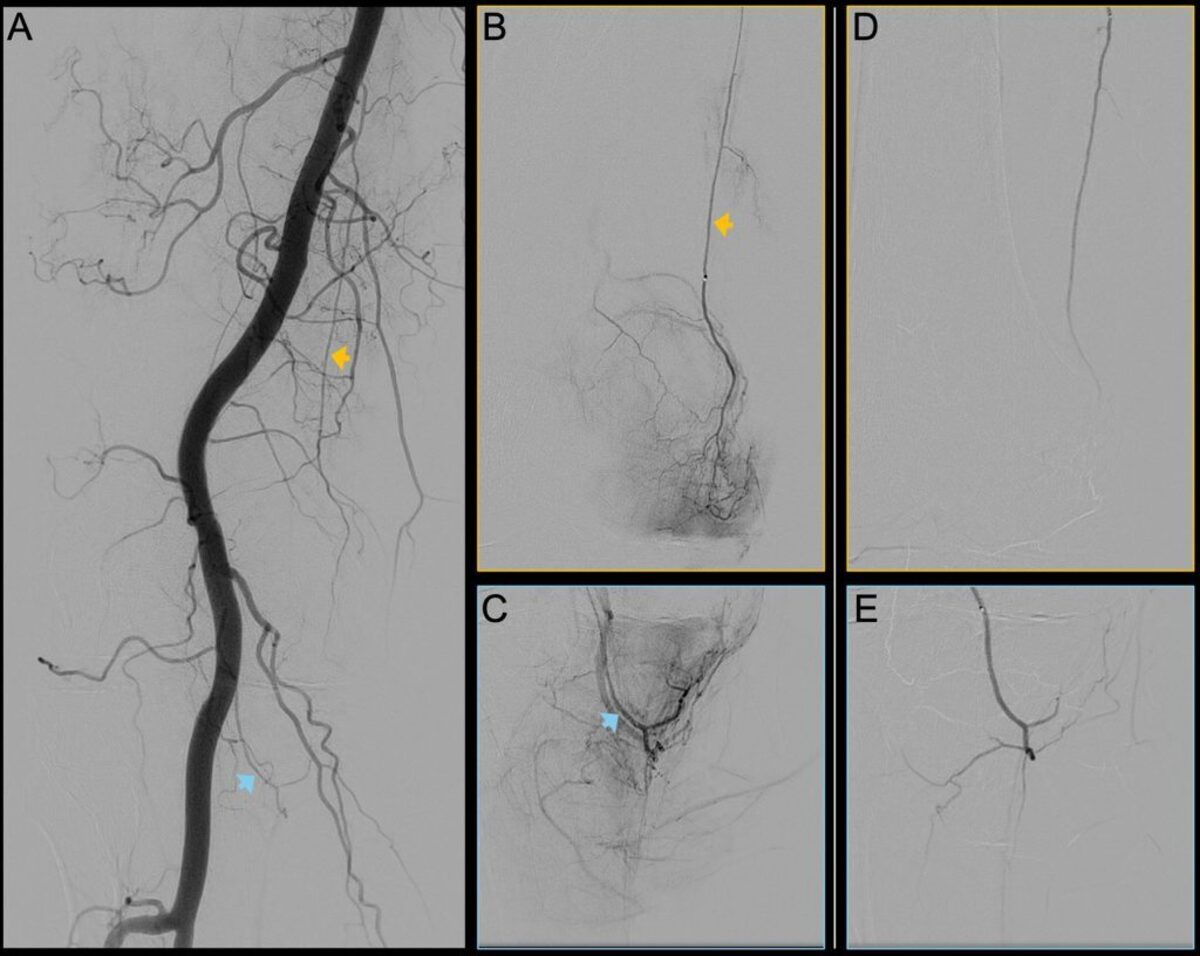  Digital subtraction angiography images of the right knee joint of a 62-year-old participant with predominantly medial knee osteoarthritis (OA). (A) Periinterventional image of the popliteal artery. Yellow arrow indicates the descending genicular artery, and blue arrow indicates the medial inferior genicular artery. (B, C) Selective preinterventional images show hypervascularity of two branches of the genicular artery: the (B) descending genicular artery (arrow) and the (C) medial inferior genicular artery (arrow). (D, E) Selective postinterventional images obtained after embolization with rapidly resorbable gelatin-based microspheres. Knee pain suffered by millions of people can be eased for at least 12 months using a non-surgical procedure, according to new research.Genicular artery embolisation, or GAE, is an emerging minimally invasive treatment that targets abnormal blood vessels in osteoarthritis patients. (Radiological Society of North Am via SWNS) 
