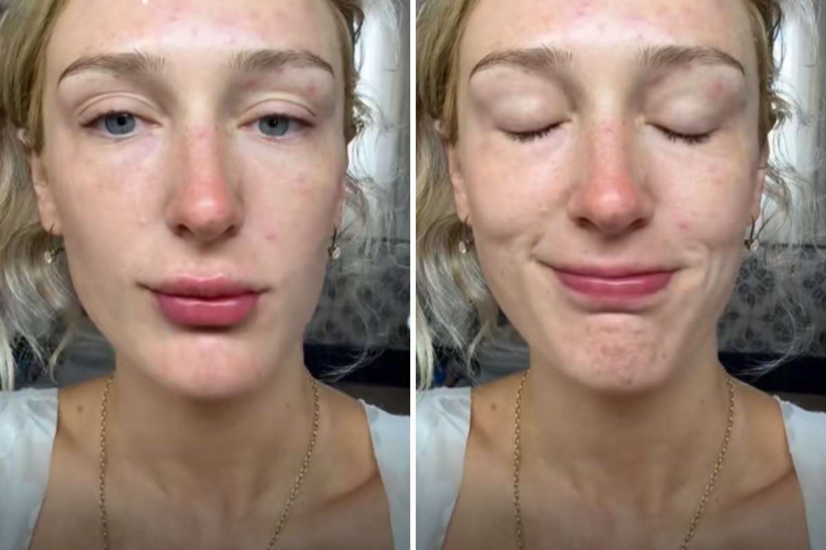  Auja Singh, 26, waking up on the day of her wedding to find dozens of mosquito bites on her face and arms. 