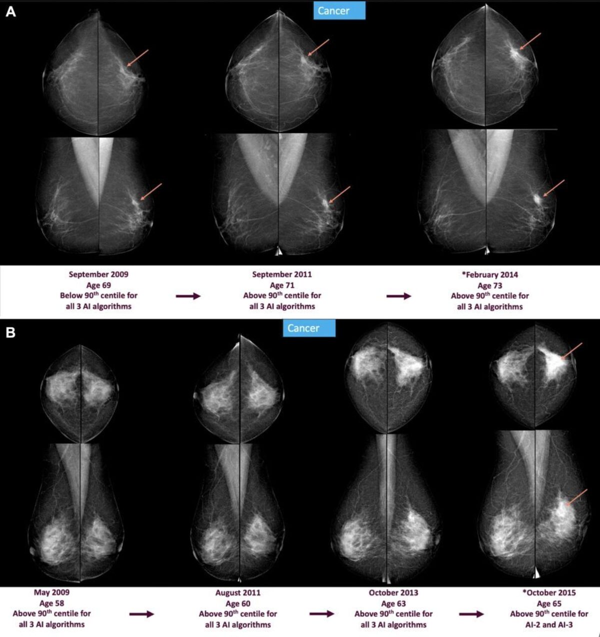  Screening mammograms and artificial intelligence (AI) score changes over time in two individuals with screen-detected cancer. Full-field digital mammograms show craniocaudal (top) and mediolateral (bottom) views of the left and right breast. (RSNA via SWNS) 