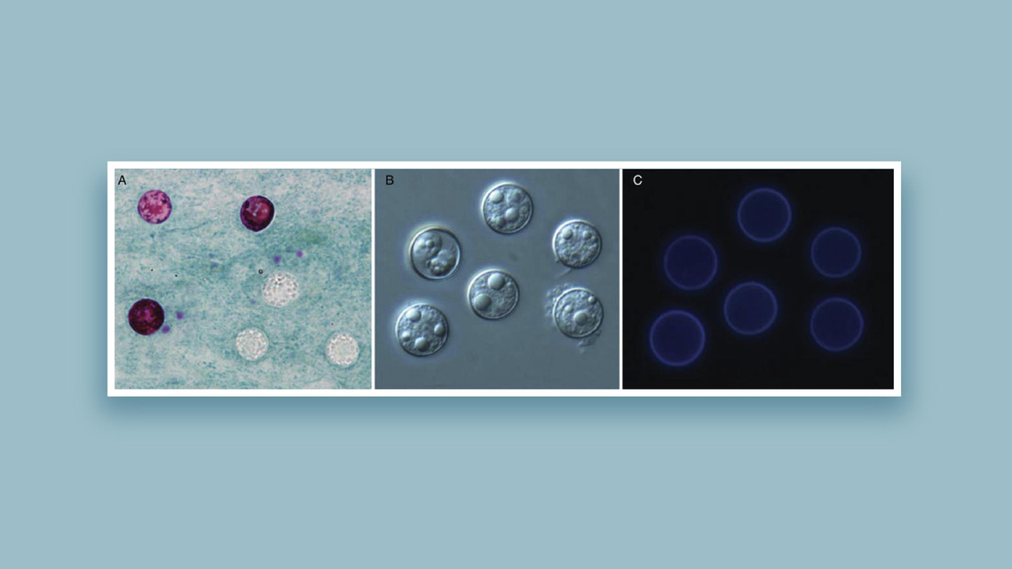 Cyclosporiasis outbreak hits record levels. See cases by state