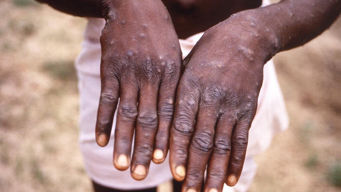 Update | Tri-Cities man in his 50s likely has 1st monkeypox case in Eastern Washington