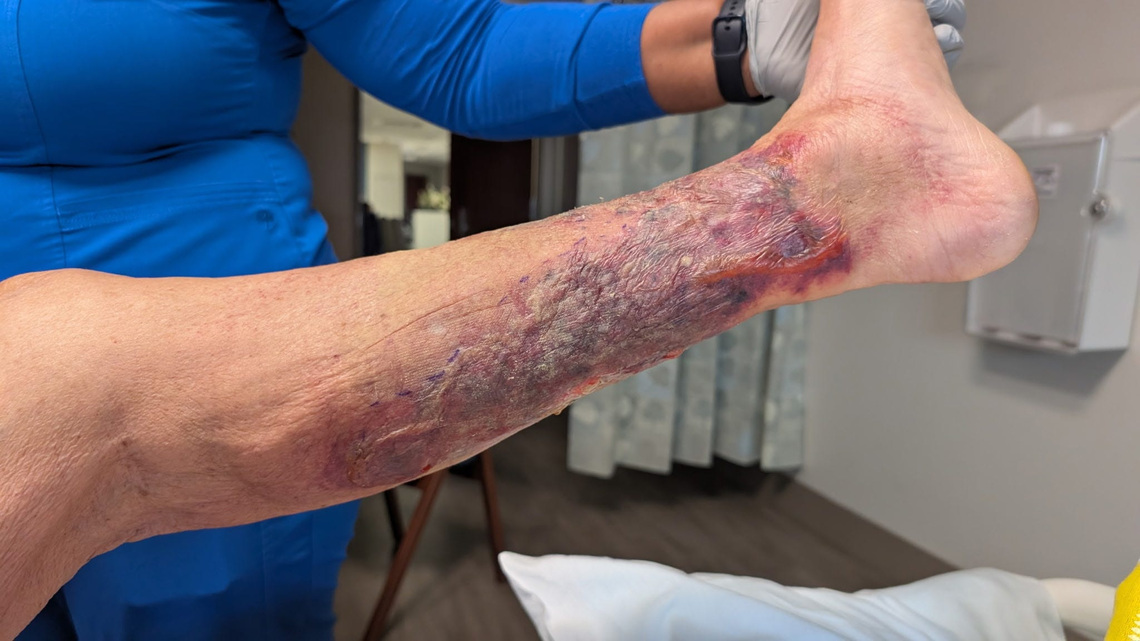 5 dead from rare flesh-eating bacteria in Louisiana 
