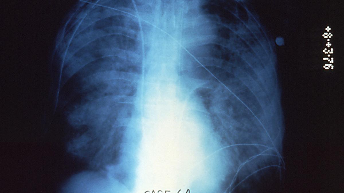 Legionnaire’s disease x-ray. This illustrative image shows an X-ray the chest of a patient with Legionnaires’ disease (LD), caused by the Legionella pneumophila bacterium.
