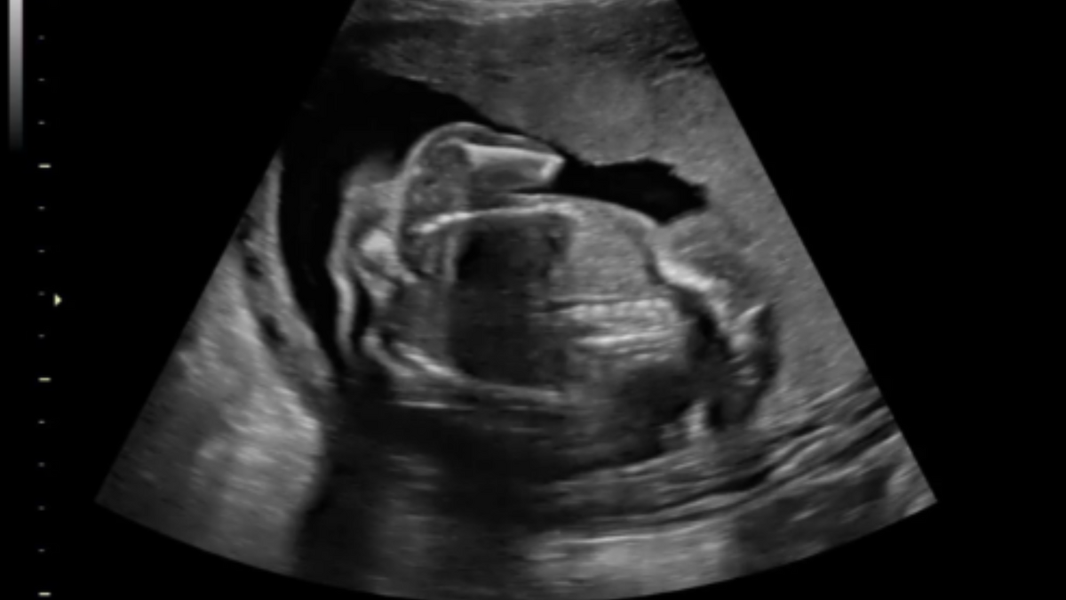 Still image of a 21-week anatomy scan. 