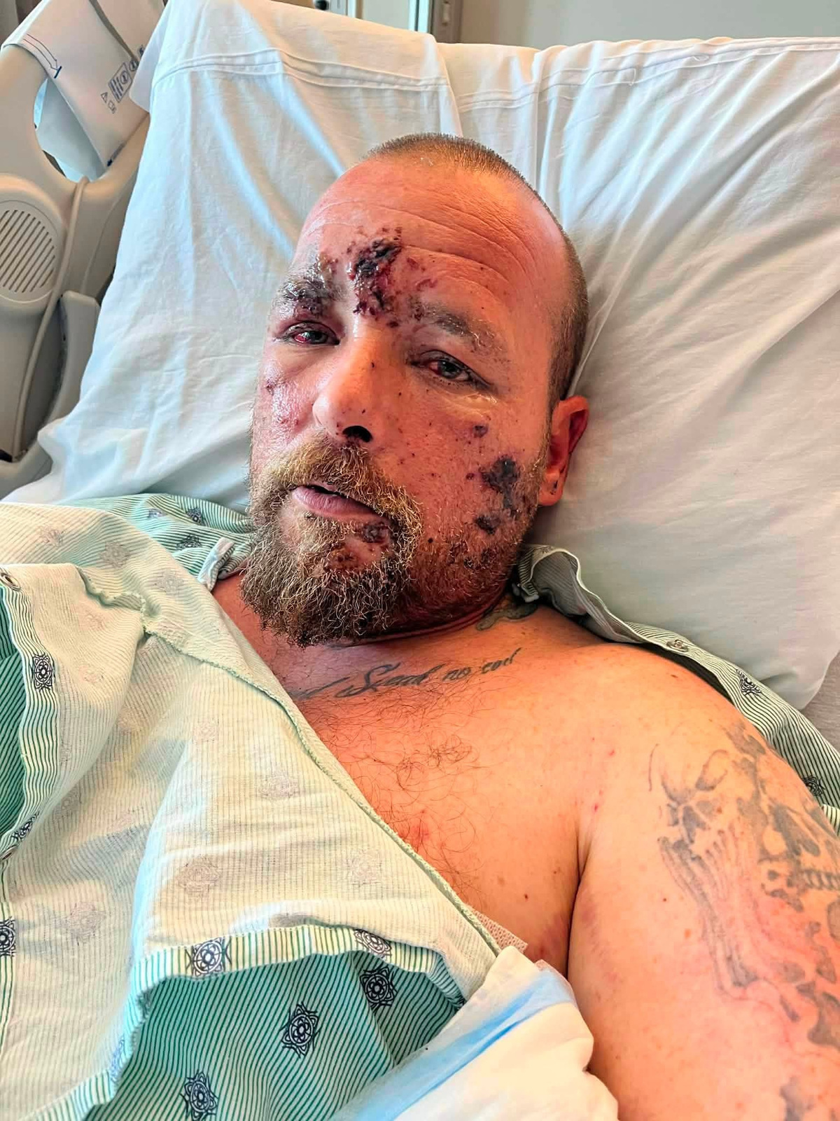 Jason Turner, 44, is lying in a hospital bed after losing his hand after a homemade firework exploded in his hand on Sunday, July 5, 2026, in Crescent City, CA.