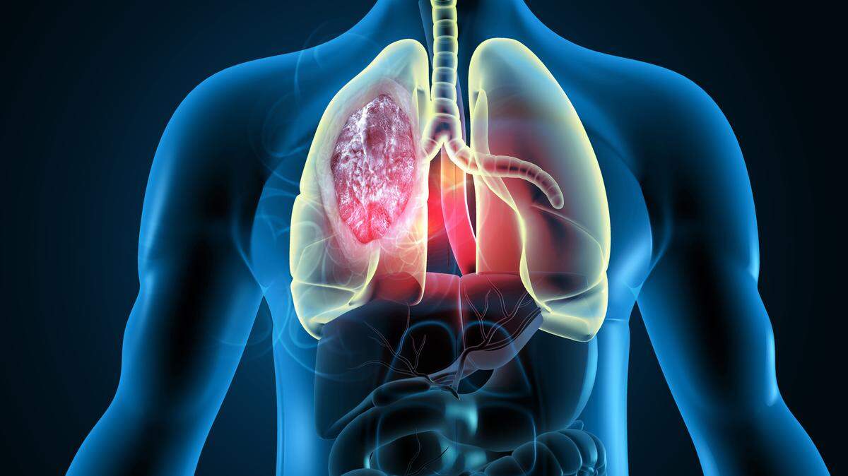 Over the past two decades, the medical community has made much progress on lung cancer, due in large part to screening programs that detect it sooner and to targeted drugs and immunotherapies that can extend life even in patients with late-stage disease.
