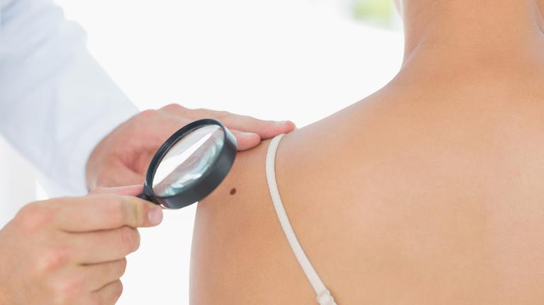 SLO hospital is hosting free skin cancer screenings. When to get checked