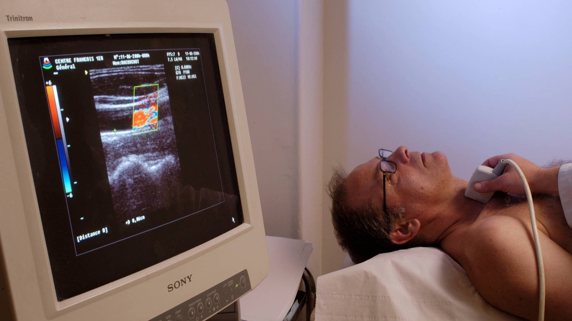 Artery Plaque Found in 57% of Adults Without Symptoms