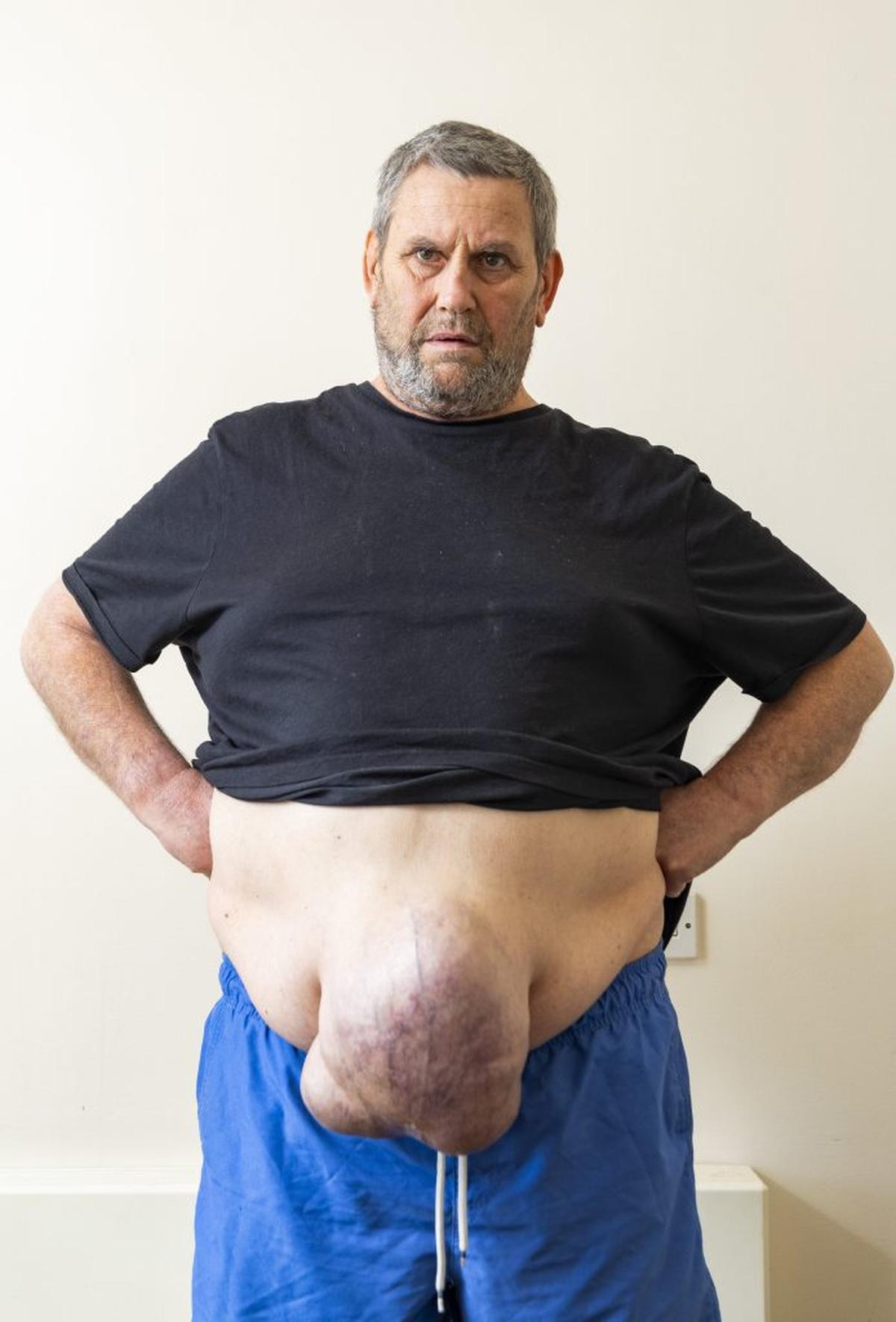  He first noticed the lump around three and a half years ago. (Tom Wren via SWNS) 
