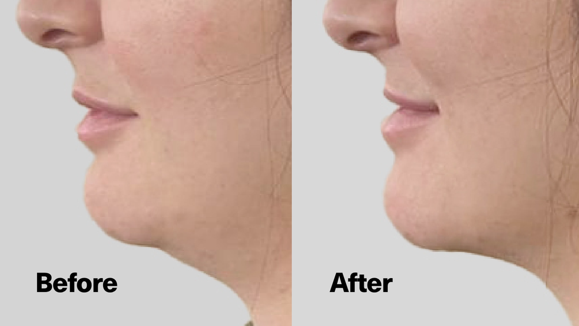 Double Chin? This Jawline-Defining Serum Lifts Sagging Skin 