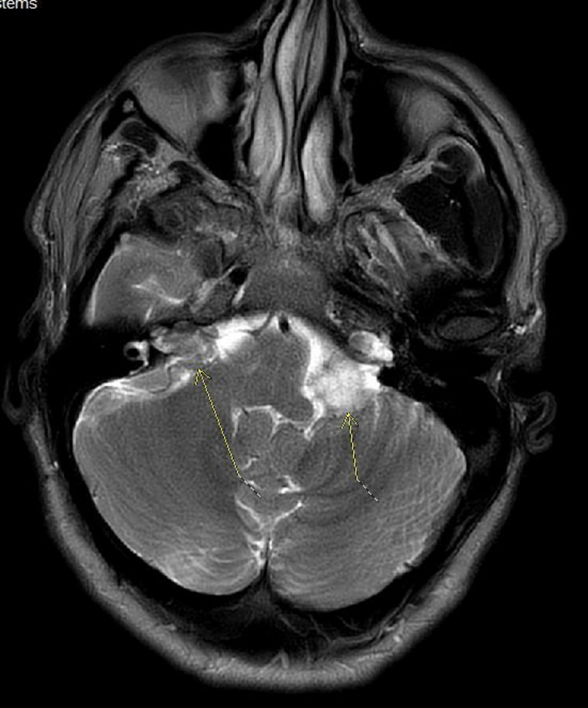  Michael Archer's brain scan. (Michael Archer via SWNS) 